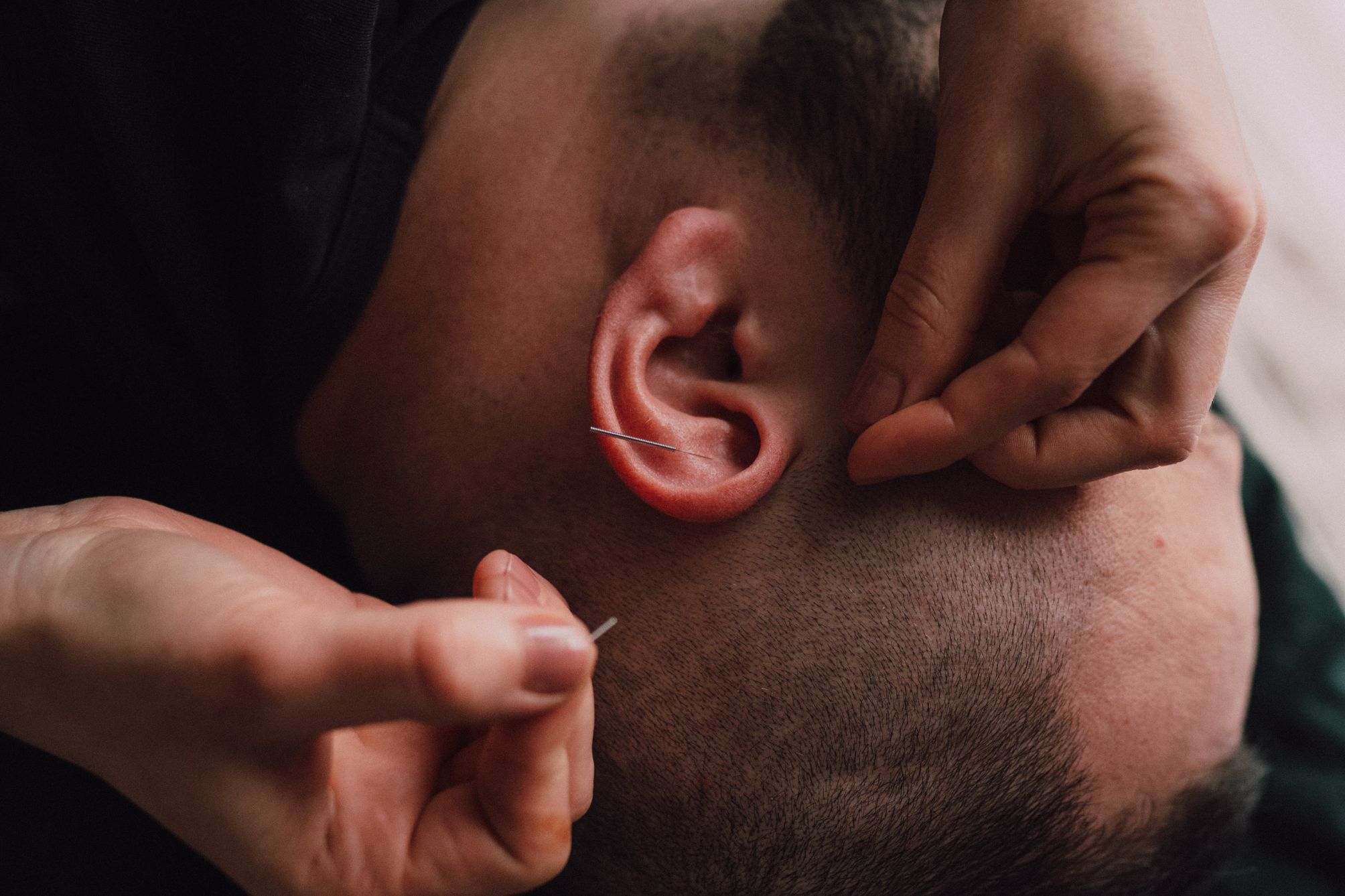Portfolio usługi Akupunktura ucha