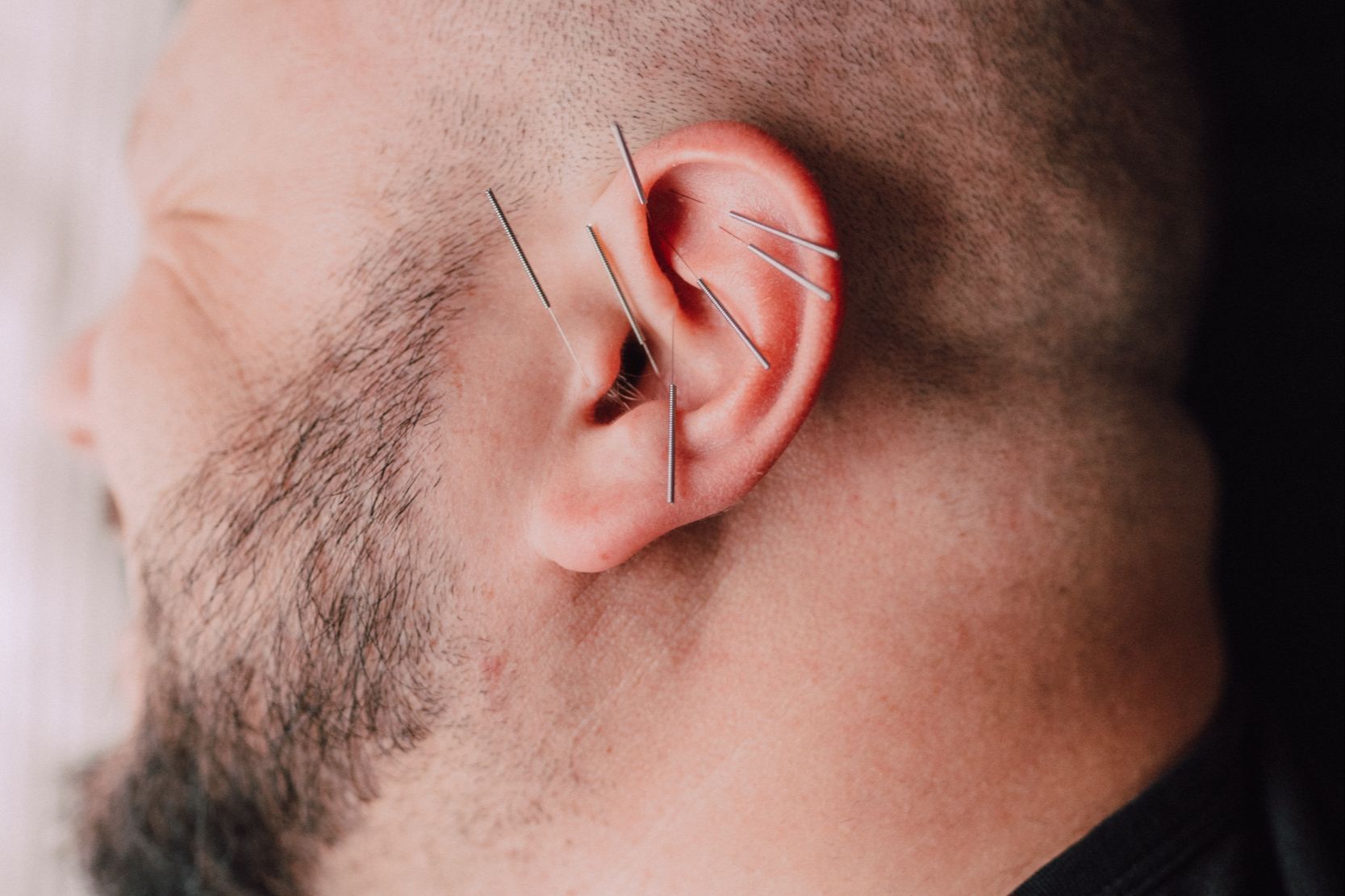 Portfolio usługi Akupunktura ucha