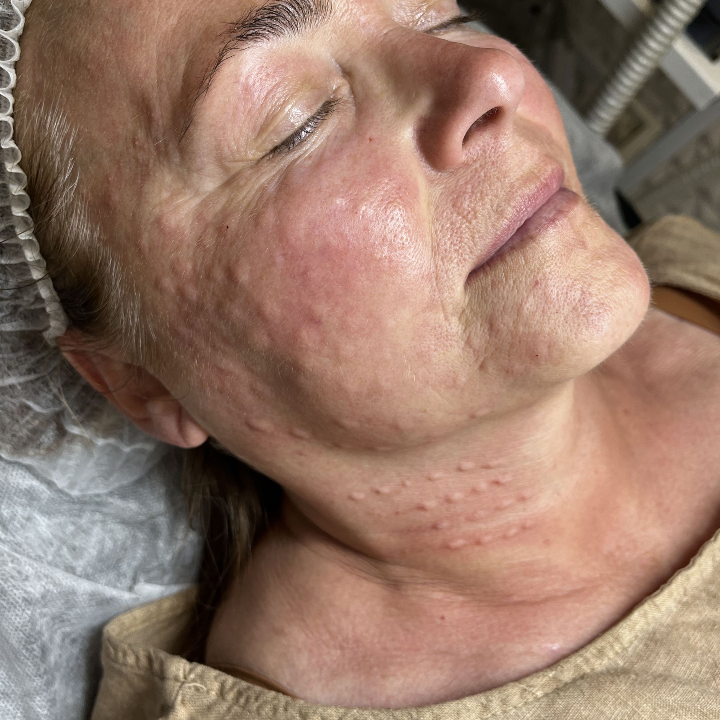 Portfolio usługi Mezoterapia igłowa twarzy