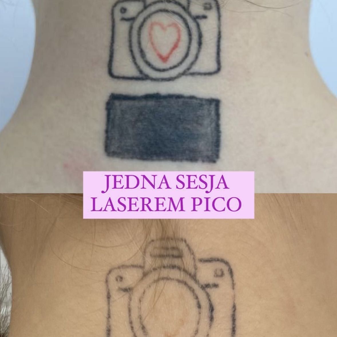 Portfolio usługi Laserowe USUWANIE Tatuażu do 20 cm2