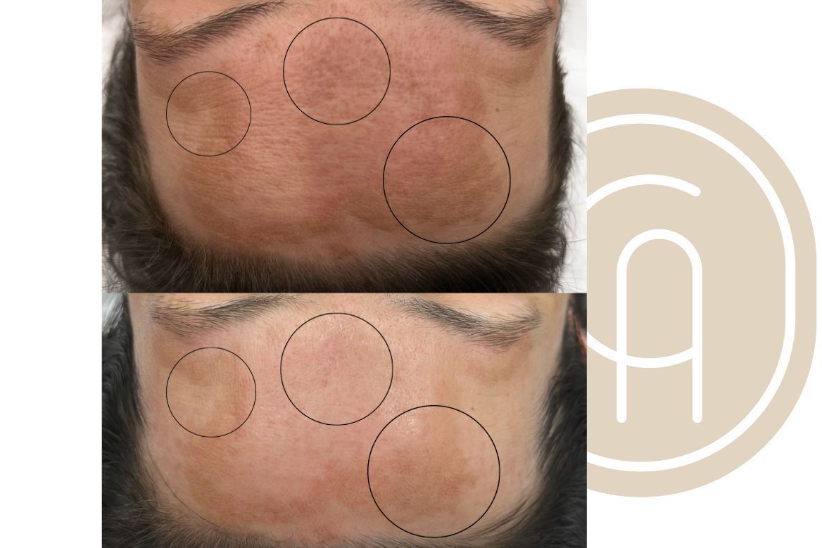 Portfolio usługi Sensi Peel PCA Skin - peeling chemiczny