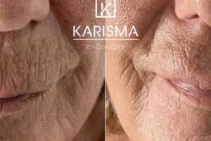 Portfolio usługi Stymulator Karisma Rh Collagen Face