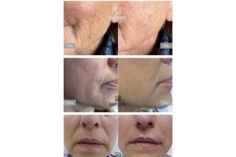 Portfolio usługi Stymulator Karisma Rh Collagen Face