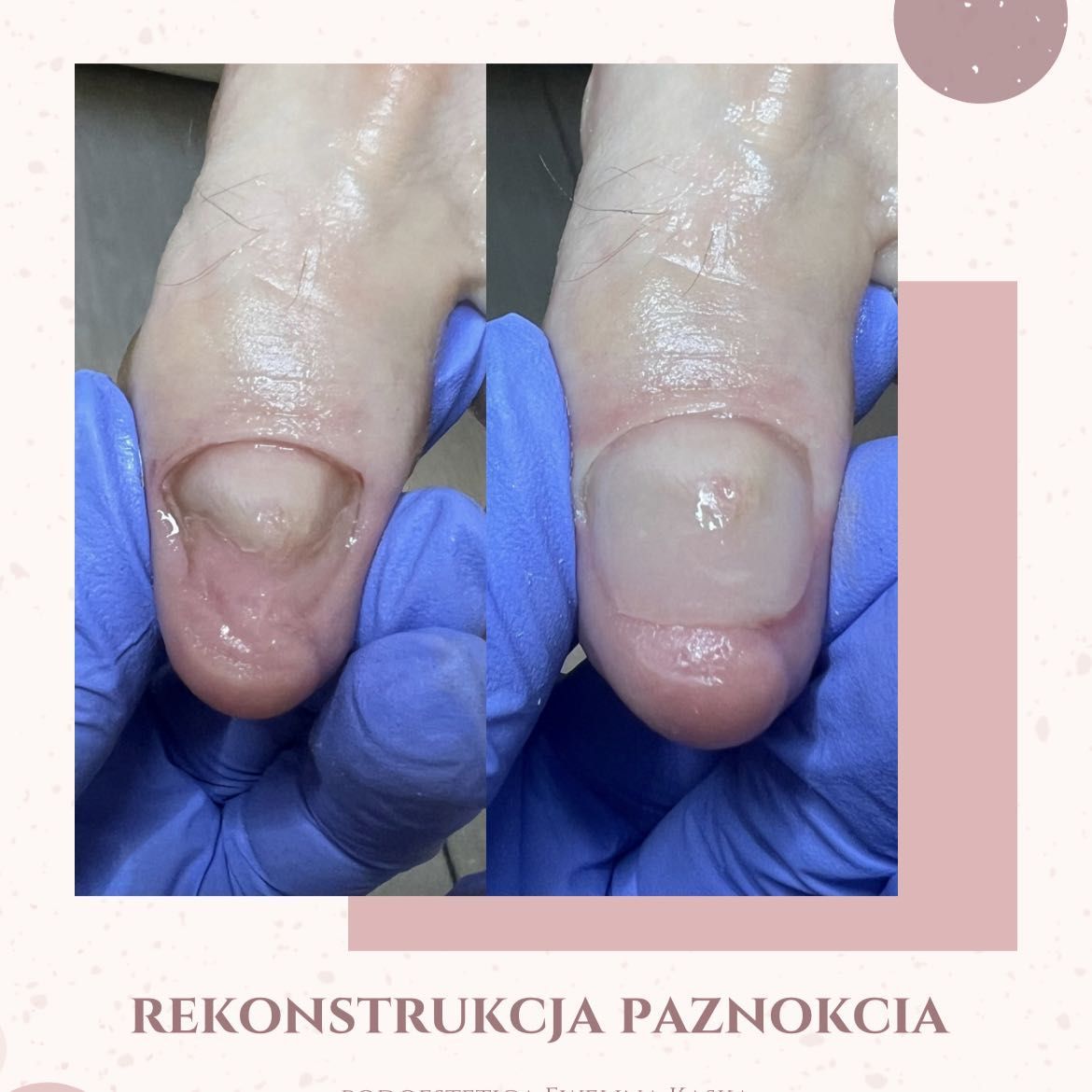 Portfolio usługi Rekonstrukcja paznokcia