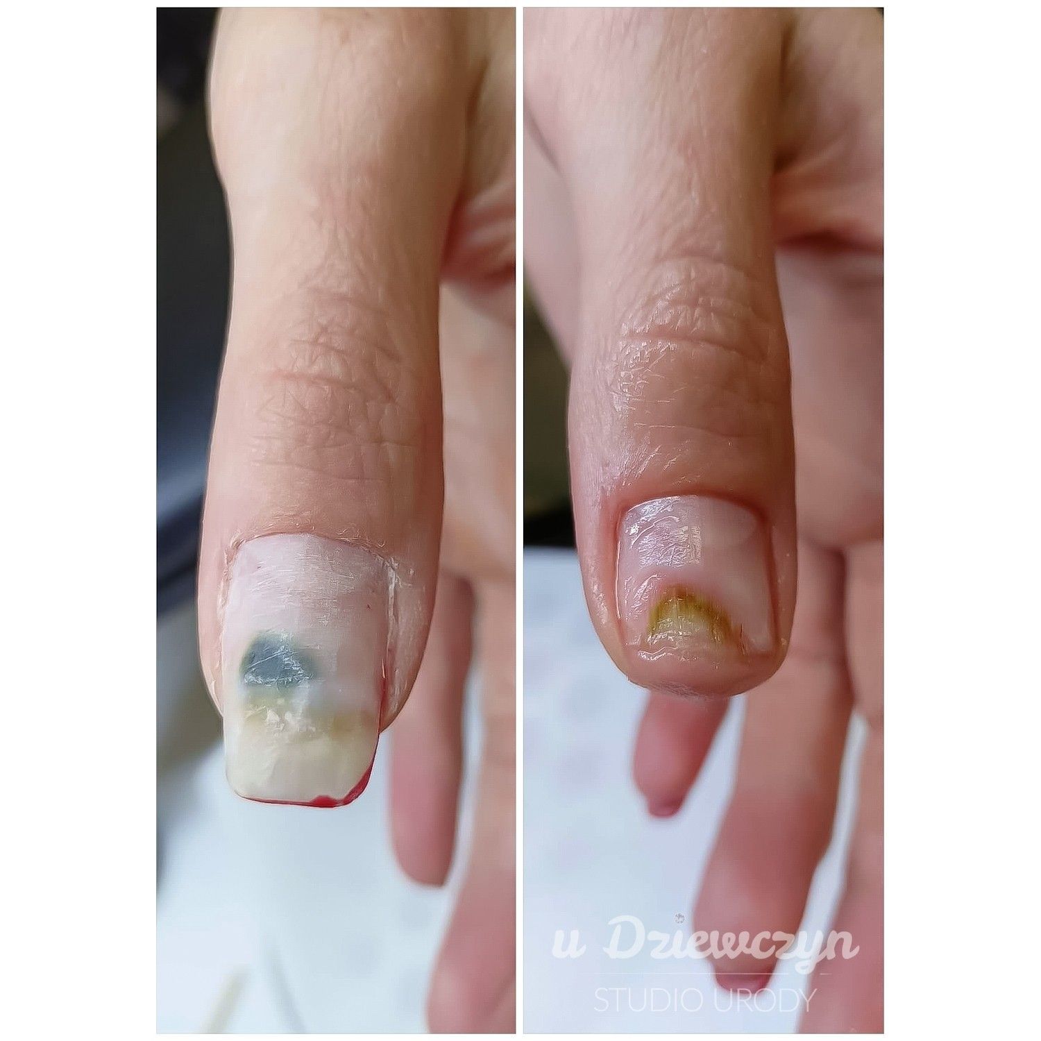 Portfolio usługi Opracowanie paznokcia zmienionego chorobowo