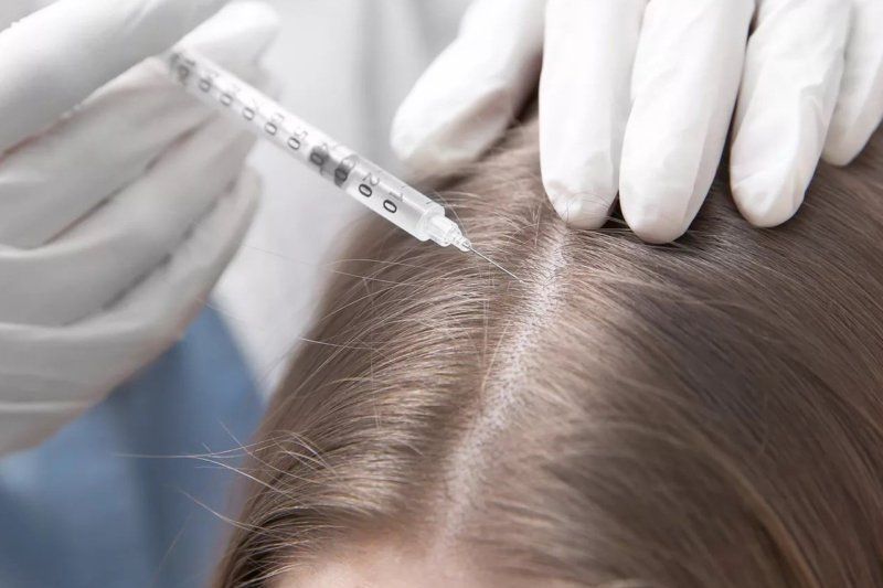 Portfolio usługi Mezoterapia skóry głowy (włosów)