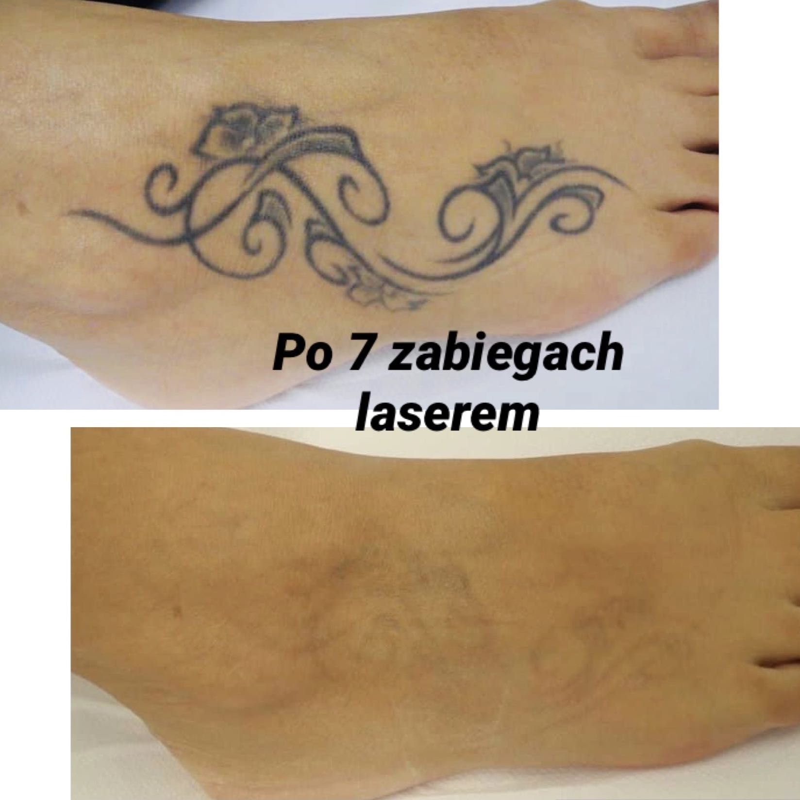Portfolio usługi Laserowe usuwanie tatuażu - mały
