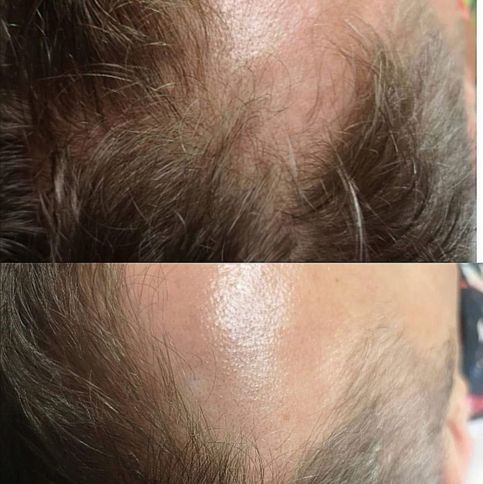Portfolio usługi Mezoterapia skóry głowy- mocne zdrowe włosy