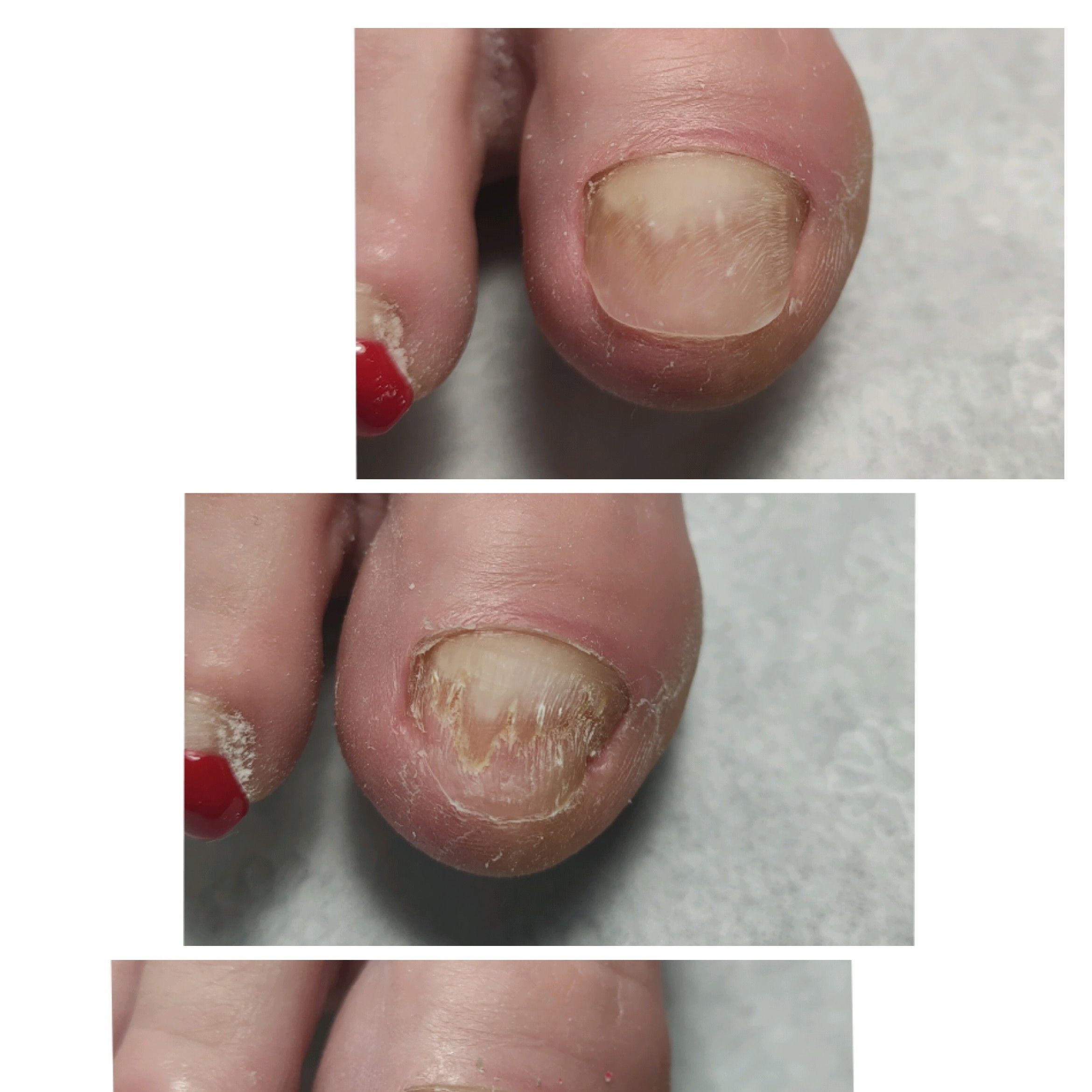 Portfolio usługi Rekonstrukcja paznokcia zmienionego chorobowo