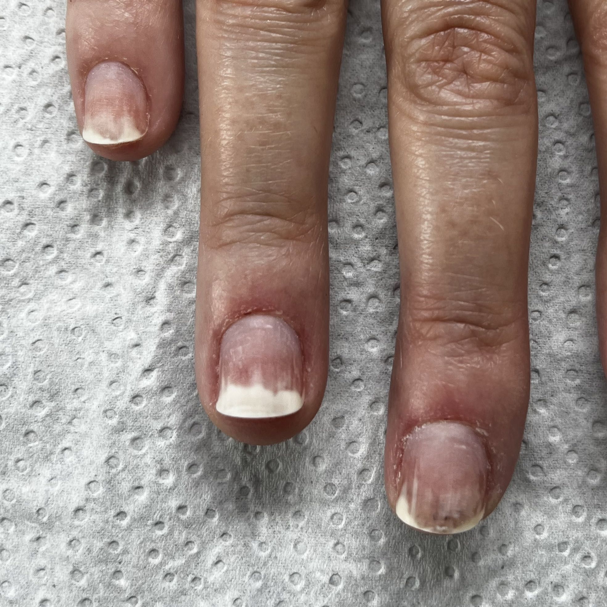 Portfolio usługi Terapia onycholizy 1 paznokieć (dłoń )