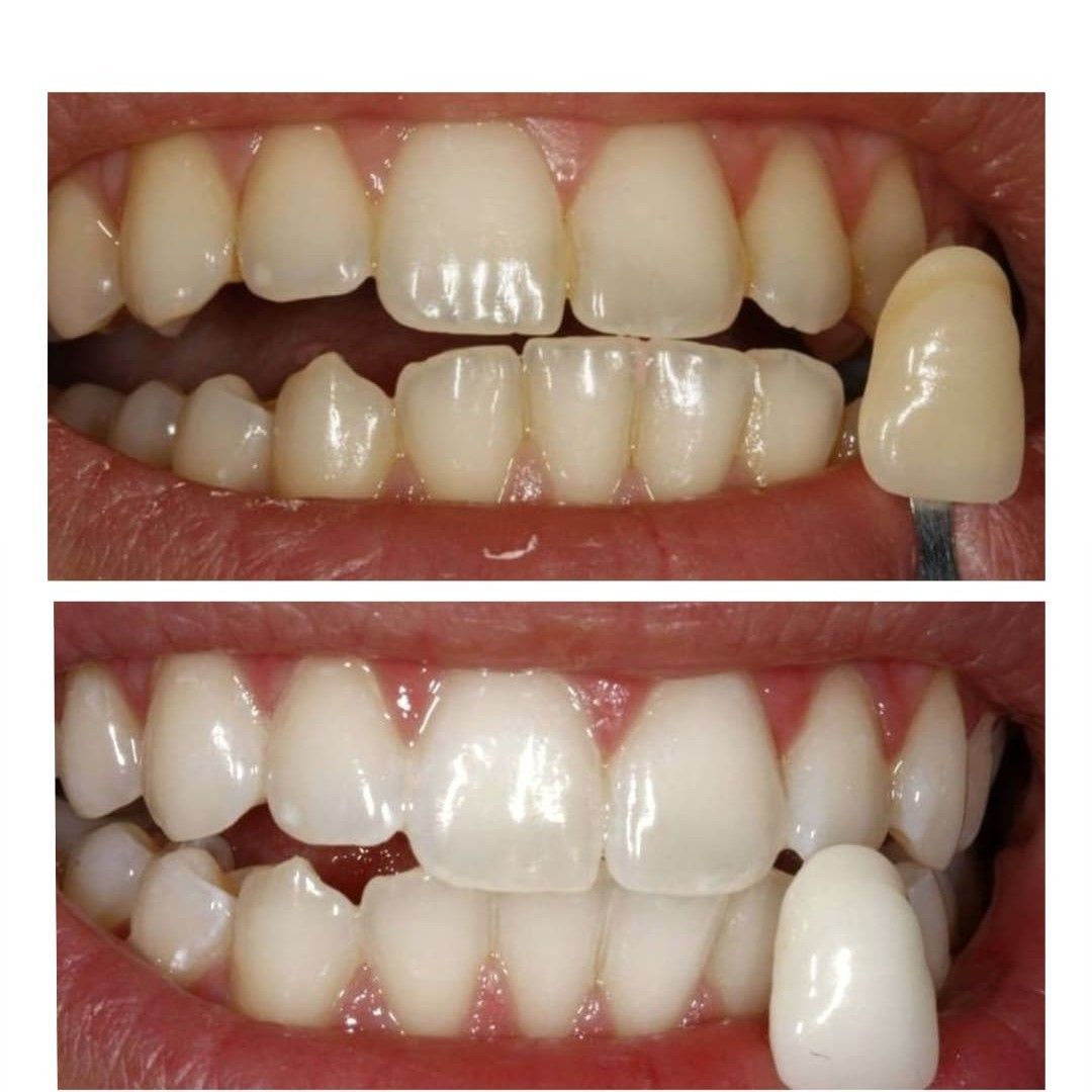 Portfolio usługi Wybielanie Zębów Beyond Polus Advanced Ultra
