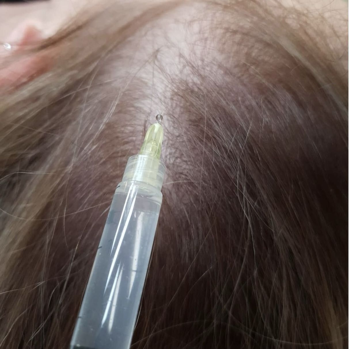 Portfolio usługi Peptydowa terapia włosów dr Cyj Hair Filler