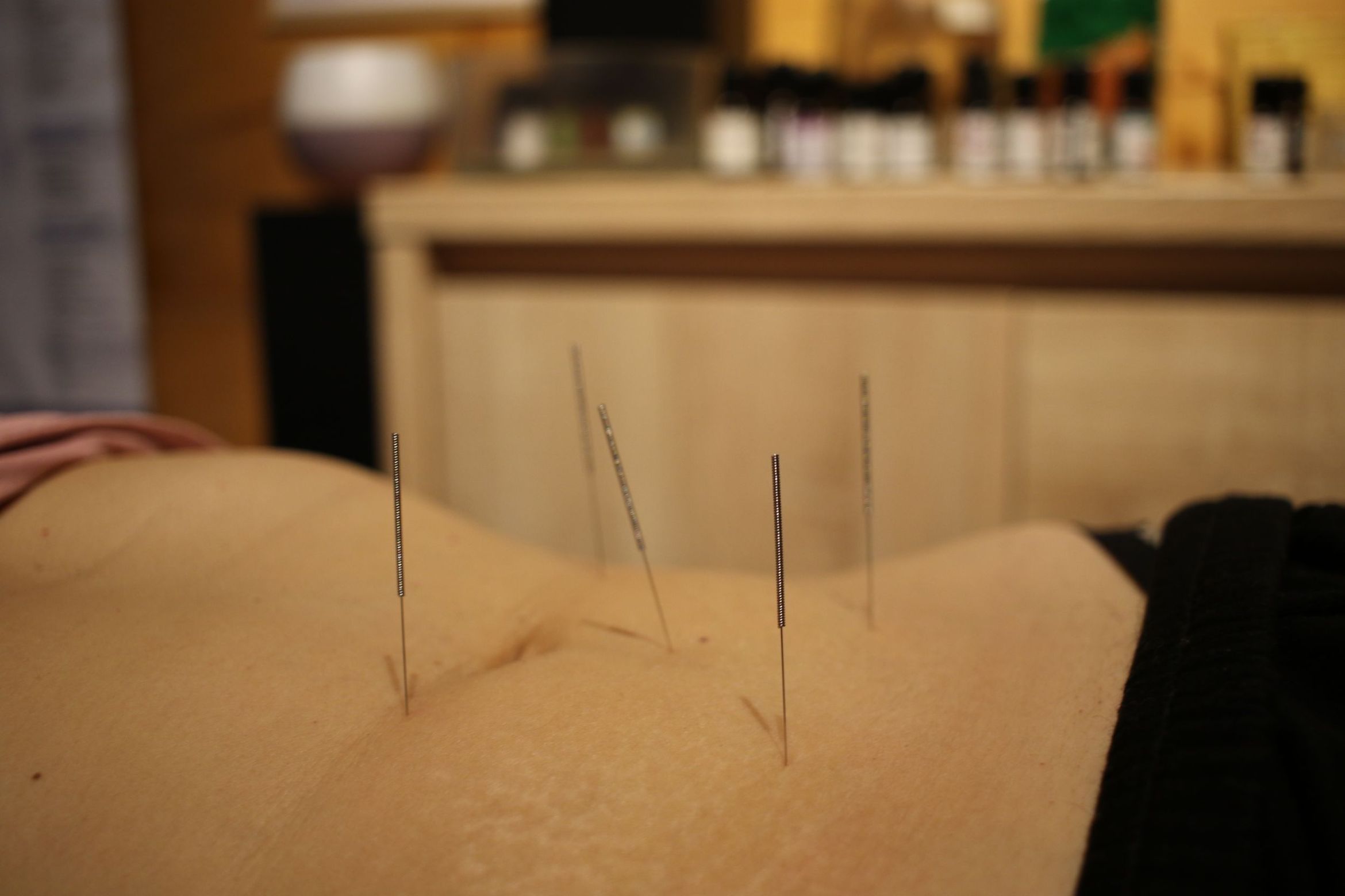 Portfolio usługi Akupunktura