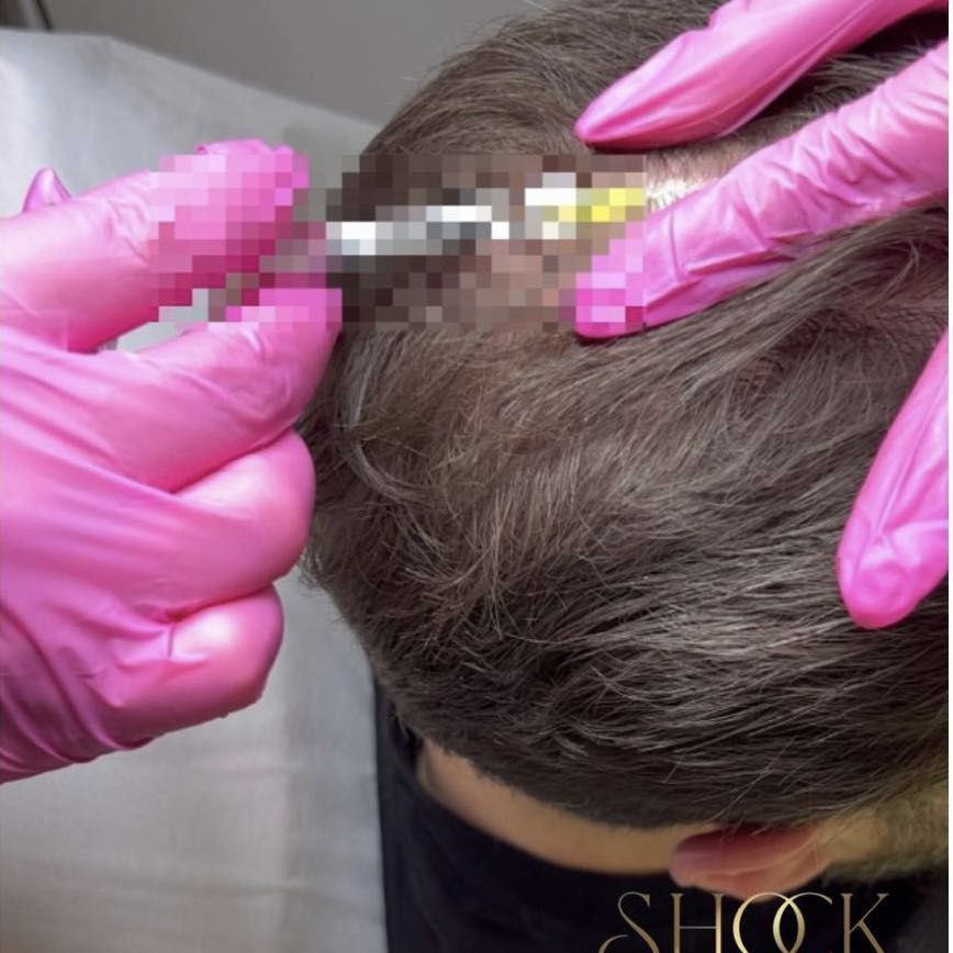 Portfolio usługi Dr. Cyj Hair Filler - 4 zabiegi