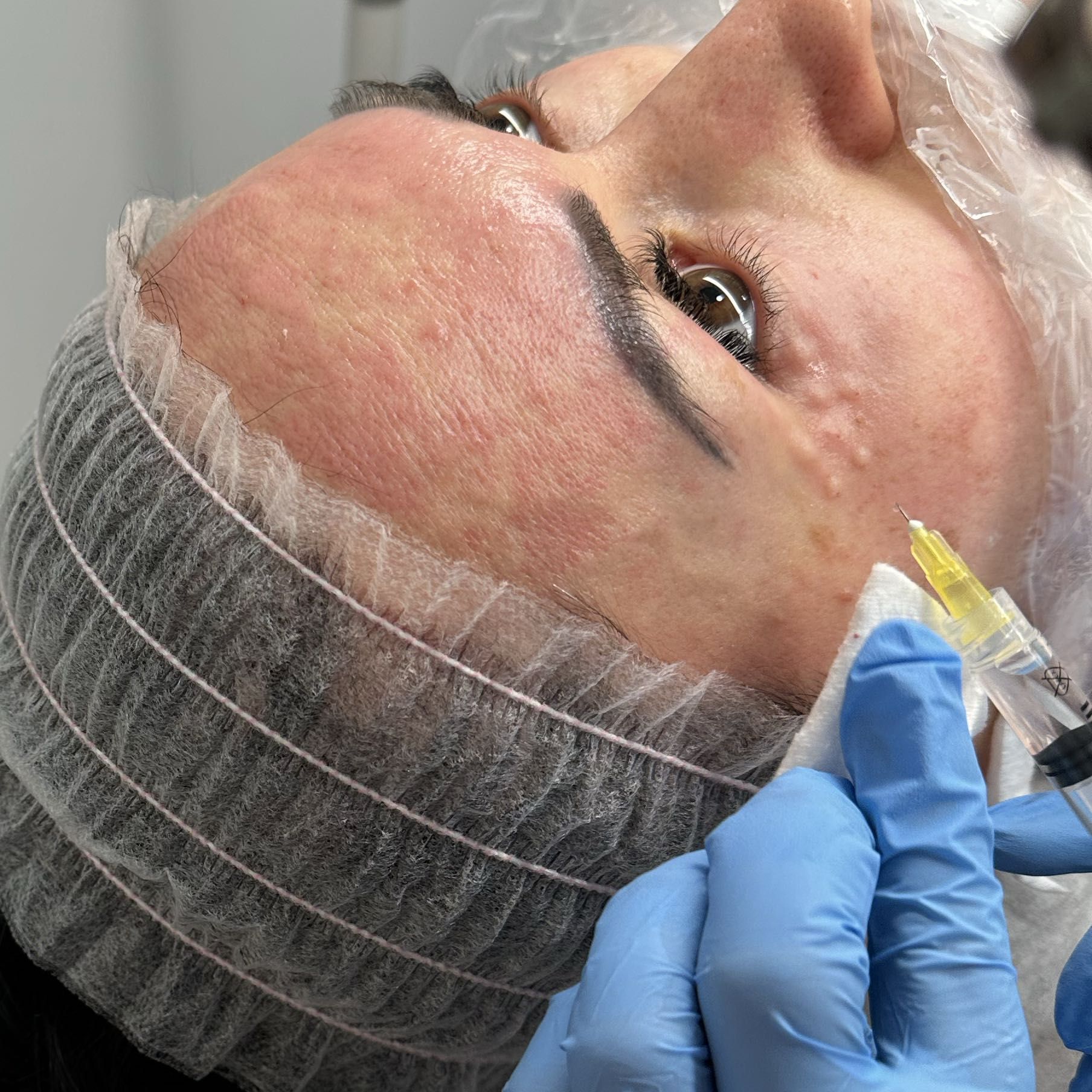 Portfolio usługi Cytocare 532 - mezoterapia igłowa twarz