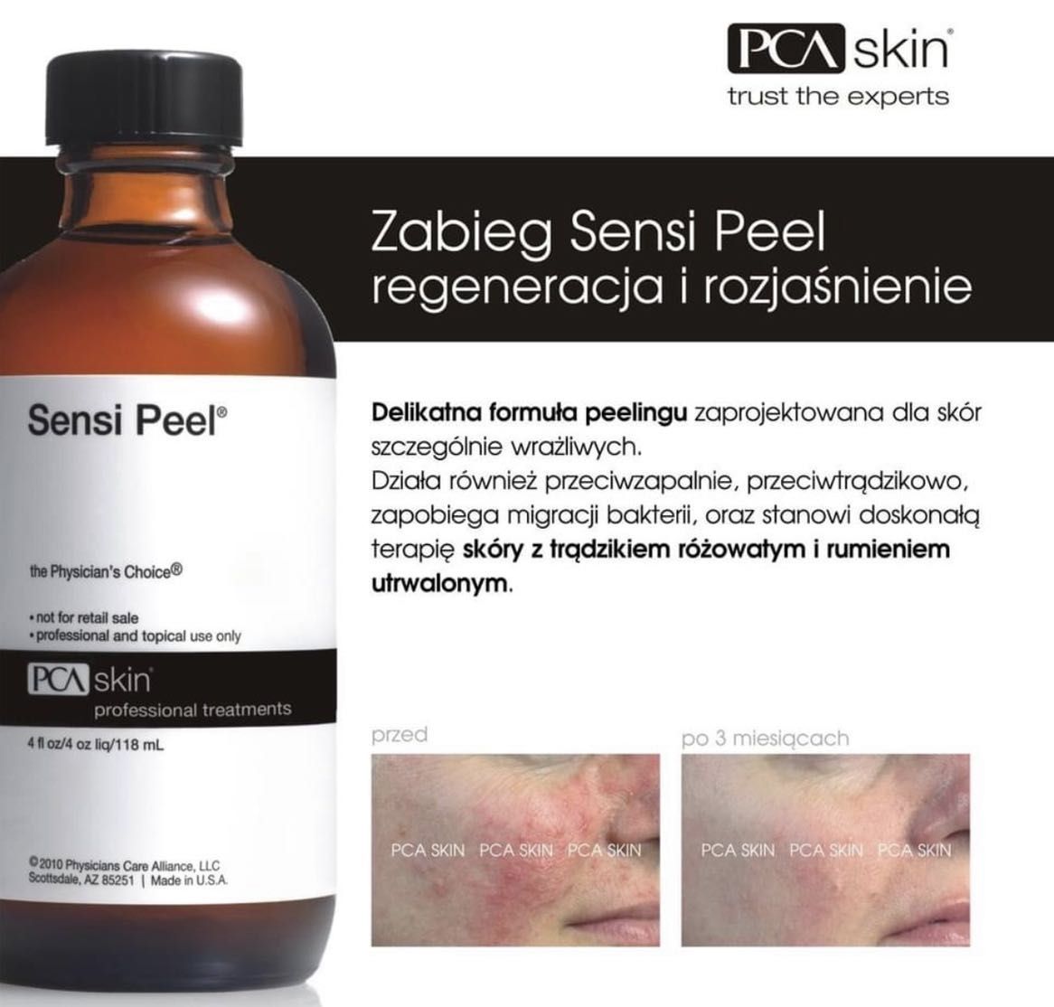 Portfolio usługi Sensi Peel PCA skin/ przebarwienia/ regeneracja