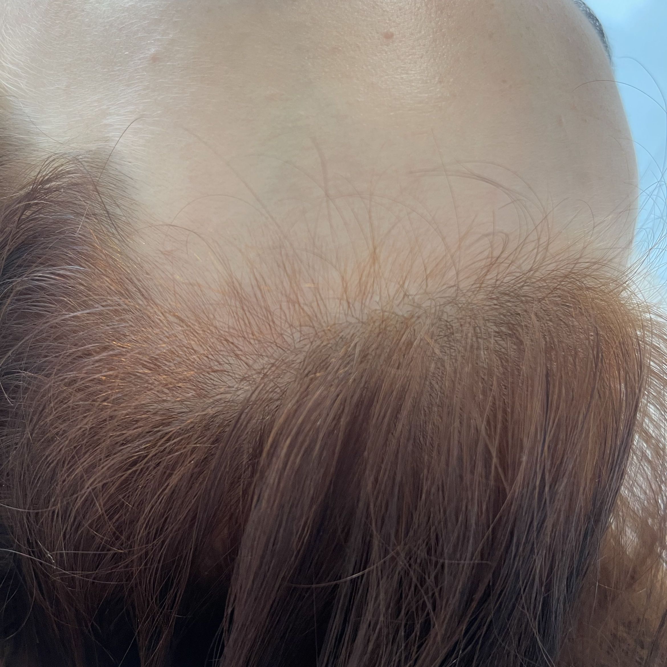 Portfolio usługi Dermation włosy - mezoterapia bezigłowa