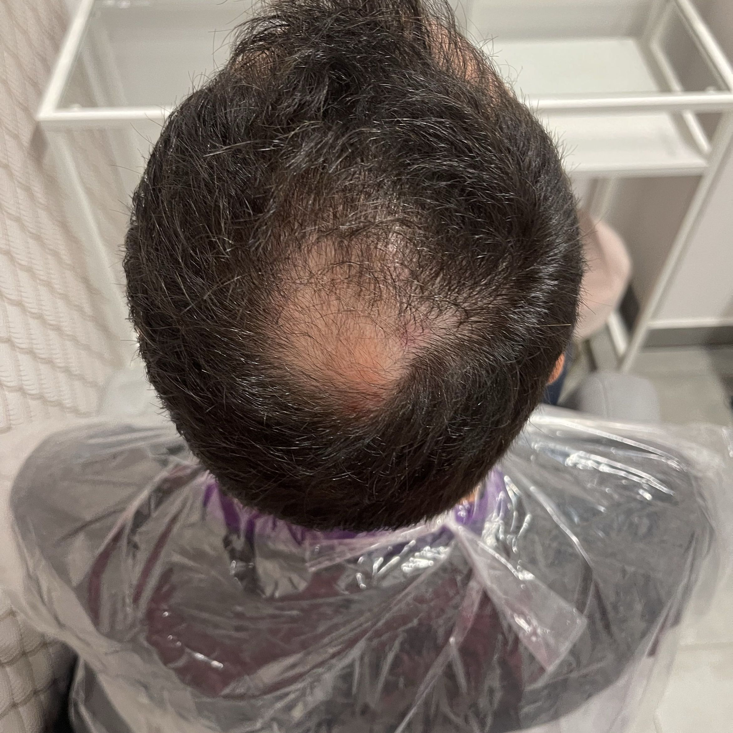 Portfolio usługi Laseroterapia z serum wzrostu włosów
