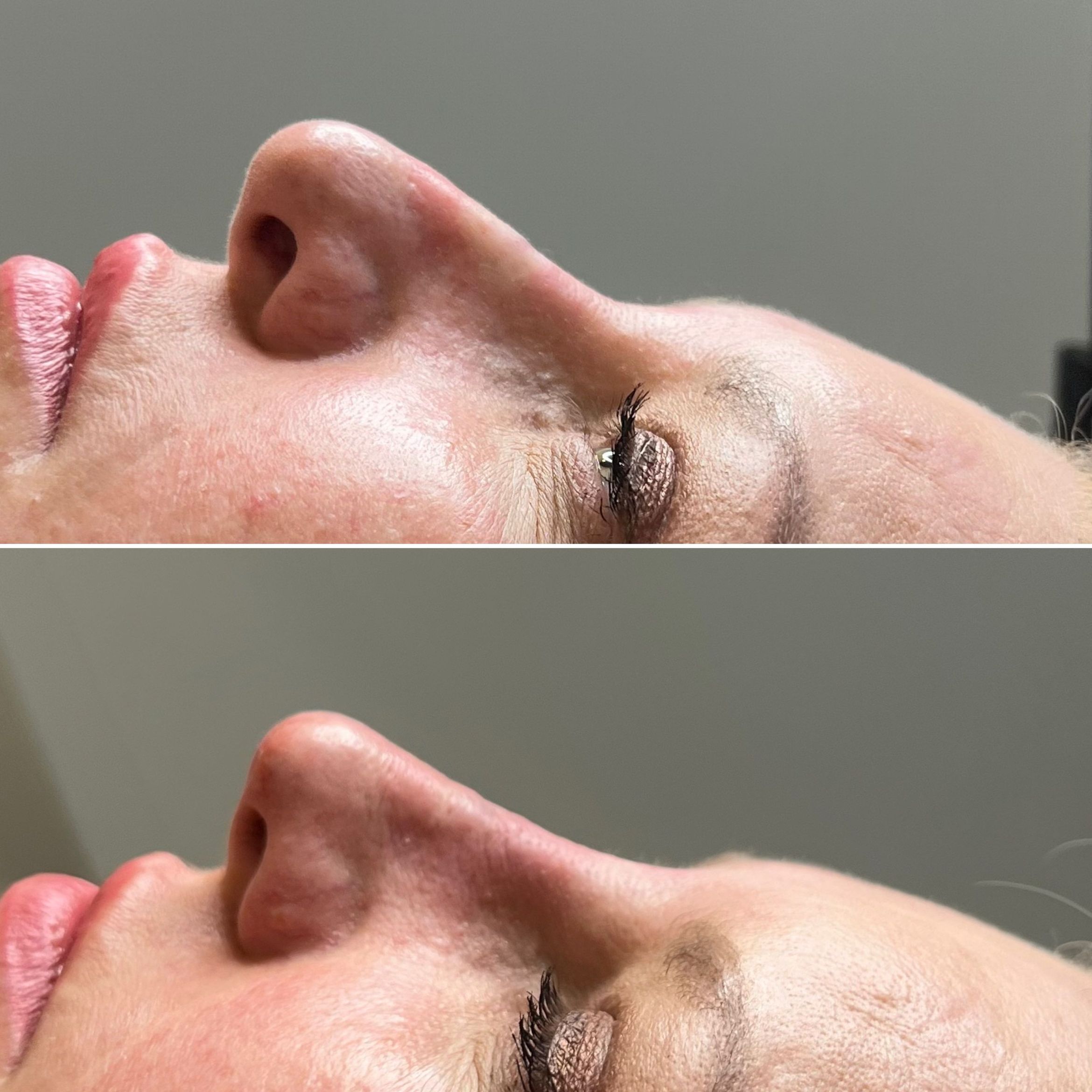Portfolio usługi Niechirurgiczna korekta nosa