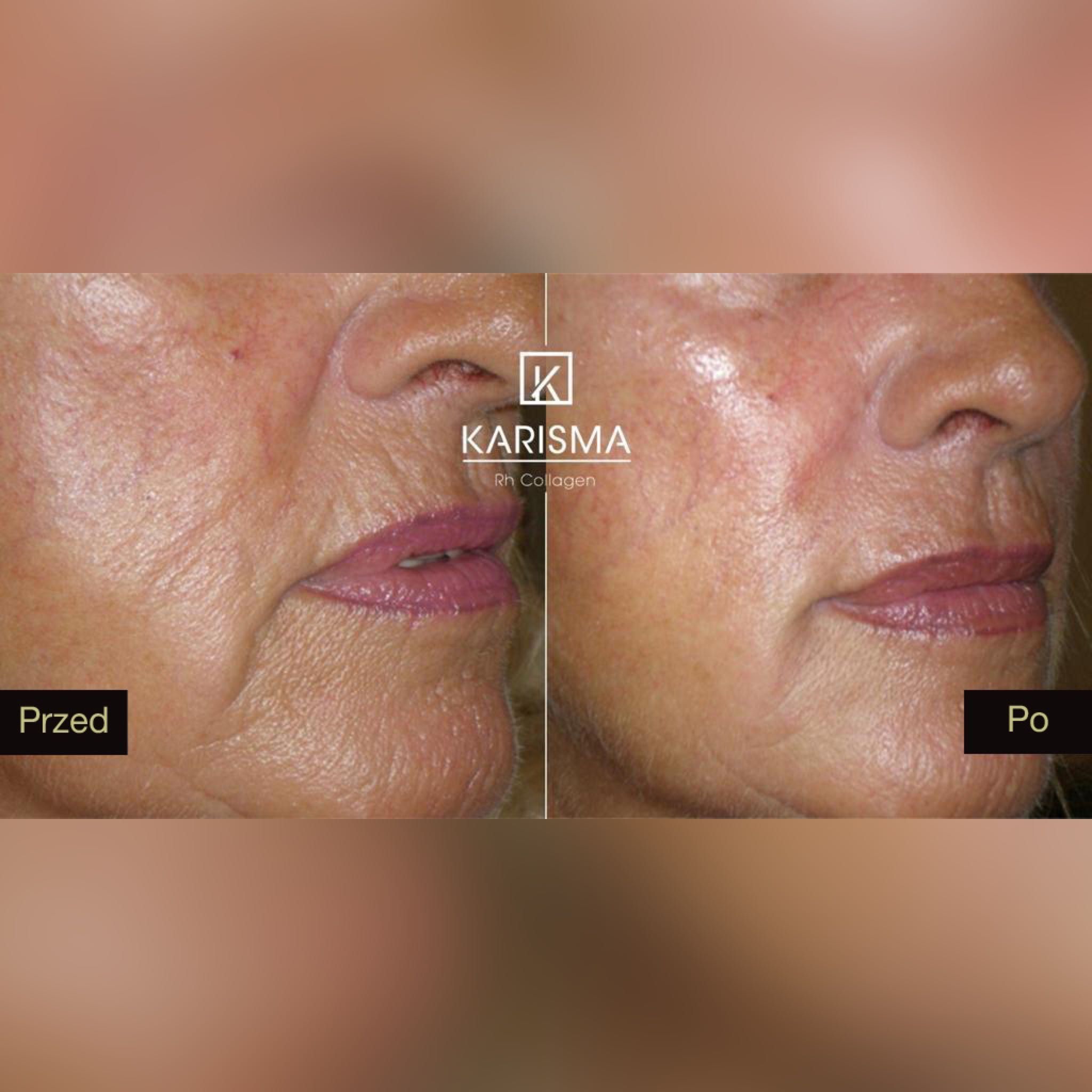 Portfolio usługi Karisma Rh Collagen Face
