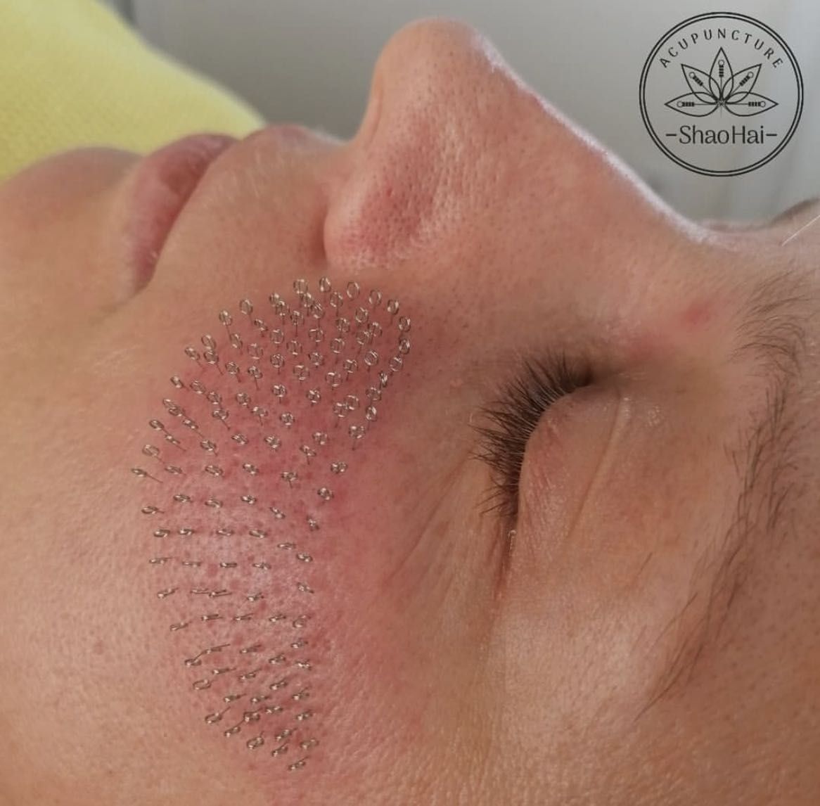 Portfolio usługi Akupunktura twarzy Pinezkowanie zmarszczek