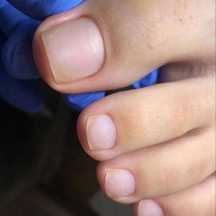 Portfolio usługi Jednostronne usunięcie wrastającego paznokcia