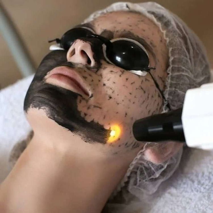 Portfolio usługi Peeling węglowy twarzy „Black Doll”