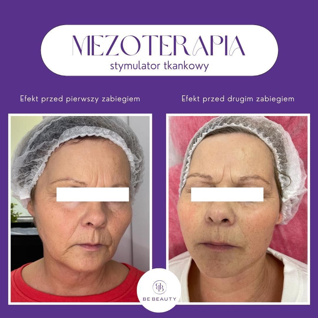 Portfolio usługi Mezoterapia mikroigłowa twarz