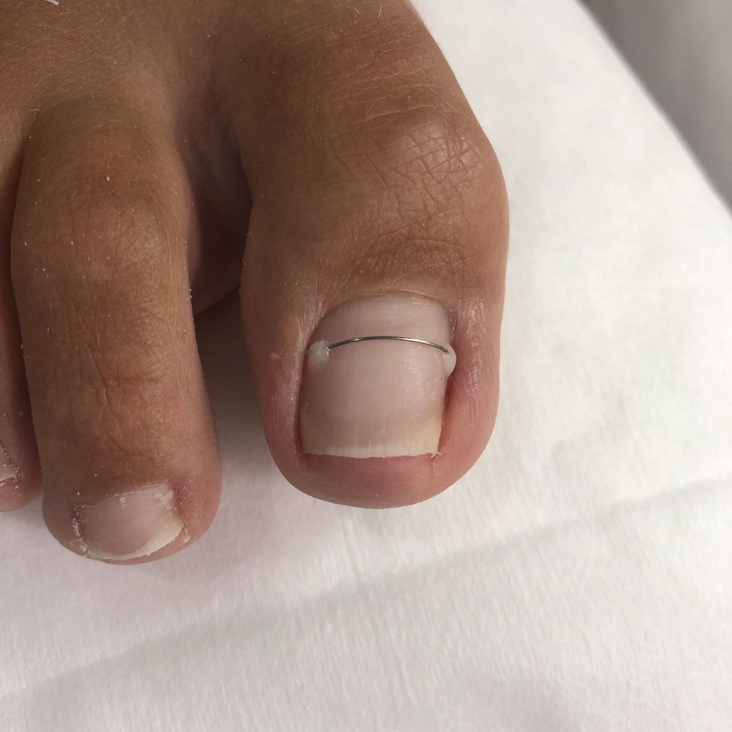 Portfolio usługi Terapia wrastających paznokci