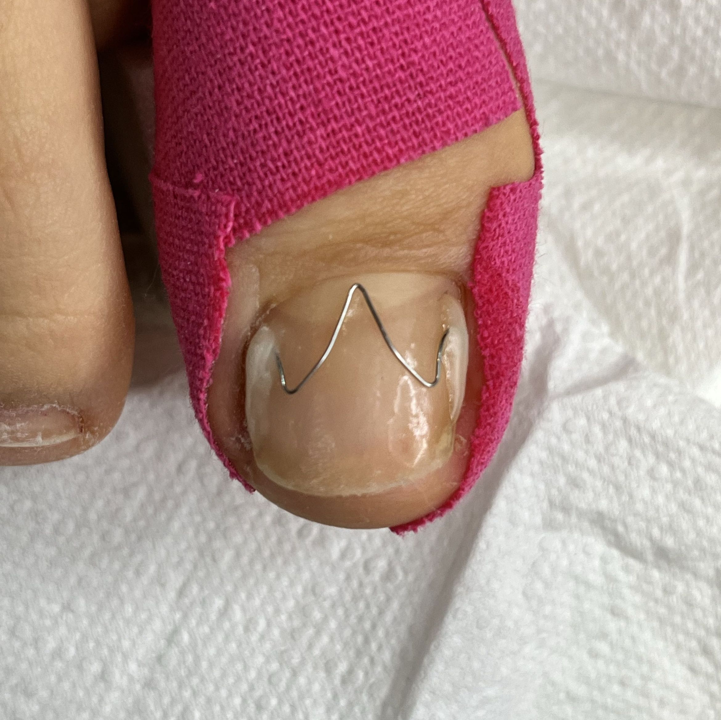 Portfolio usługi Klamra UniBrace na wrastajace paznokcie