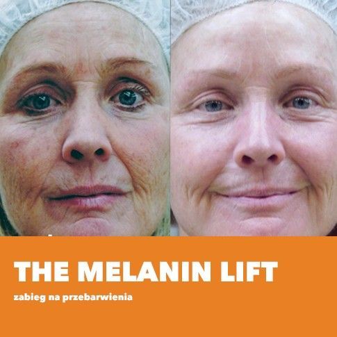 Portfolio usługi The melanin lift- rozjaśniający głęboki zabieg