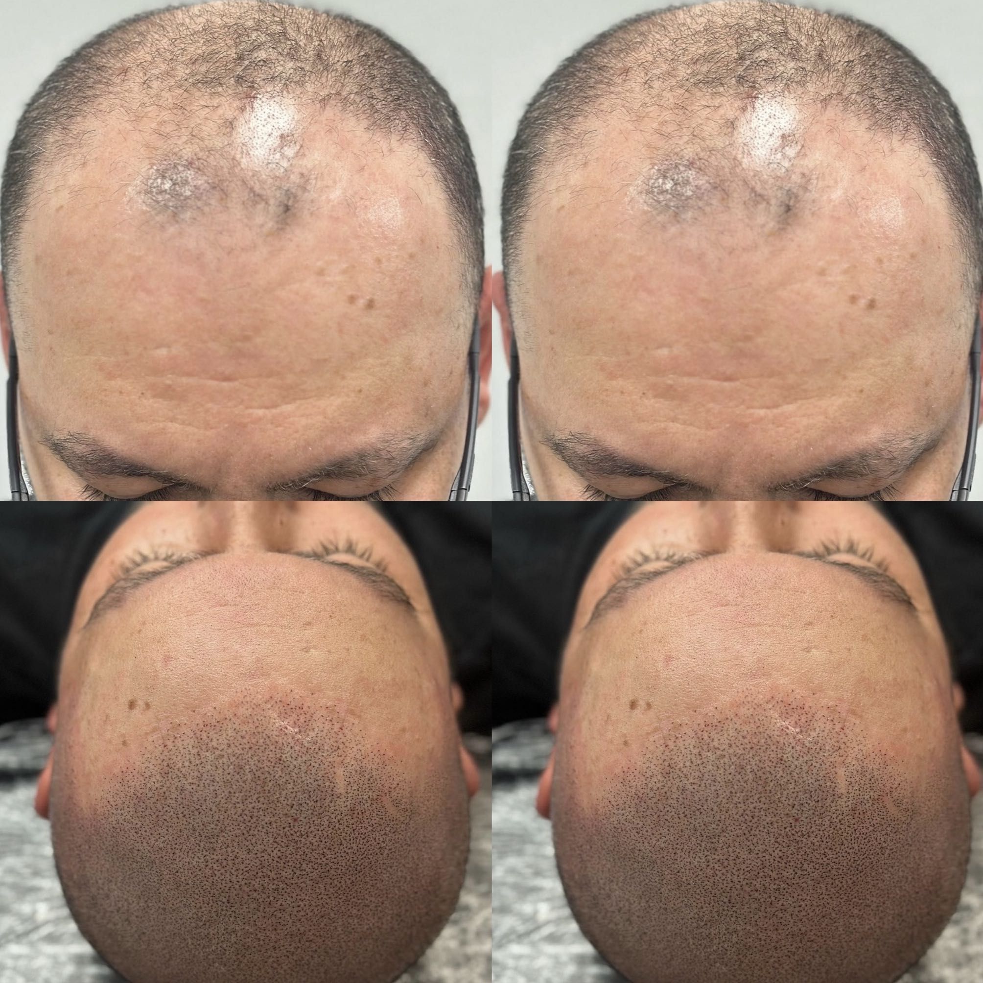 Portfolio usługi Mikropigmentacja skóry głowy