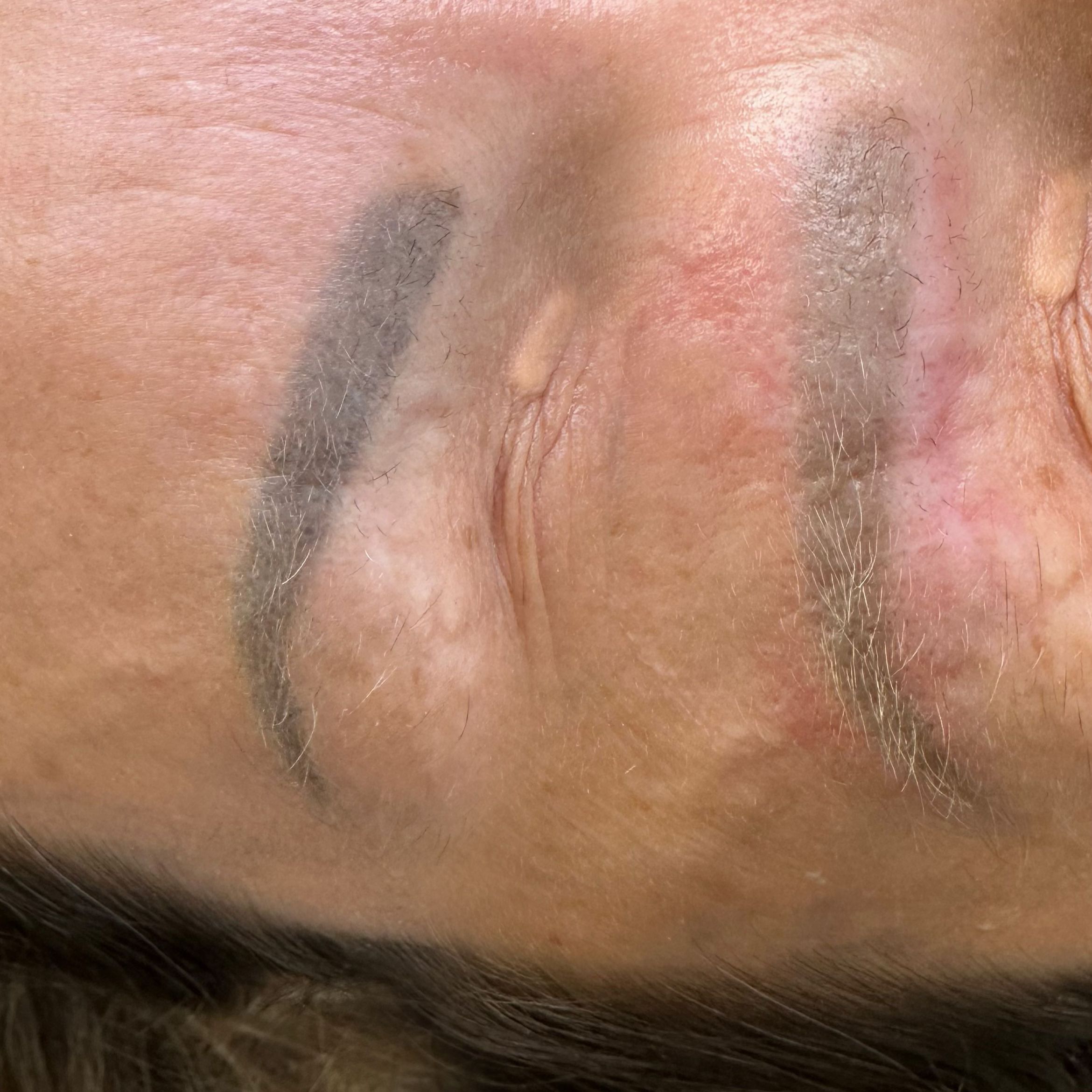 Portfolio usługi Usuwanie laserowo permanentnego makijażu brwi