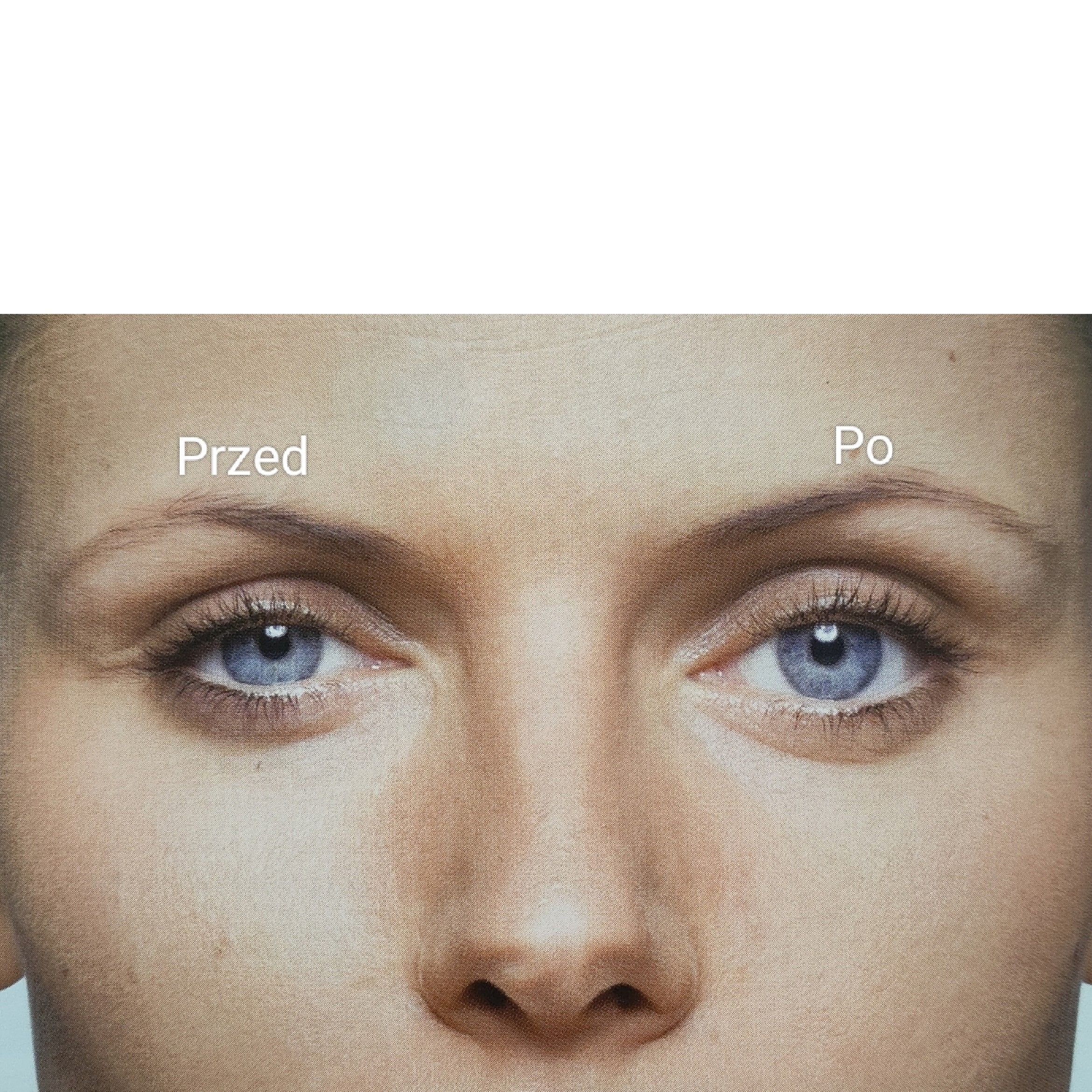 Portfolio usługi Powiększenie Oka "Poszerzenie szpary powiekowej"