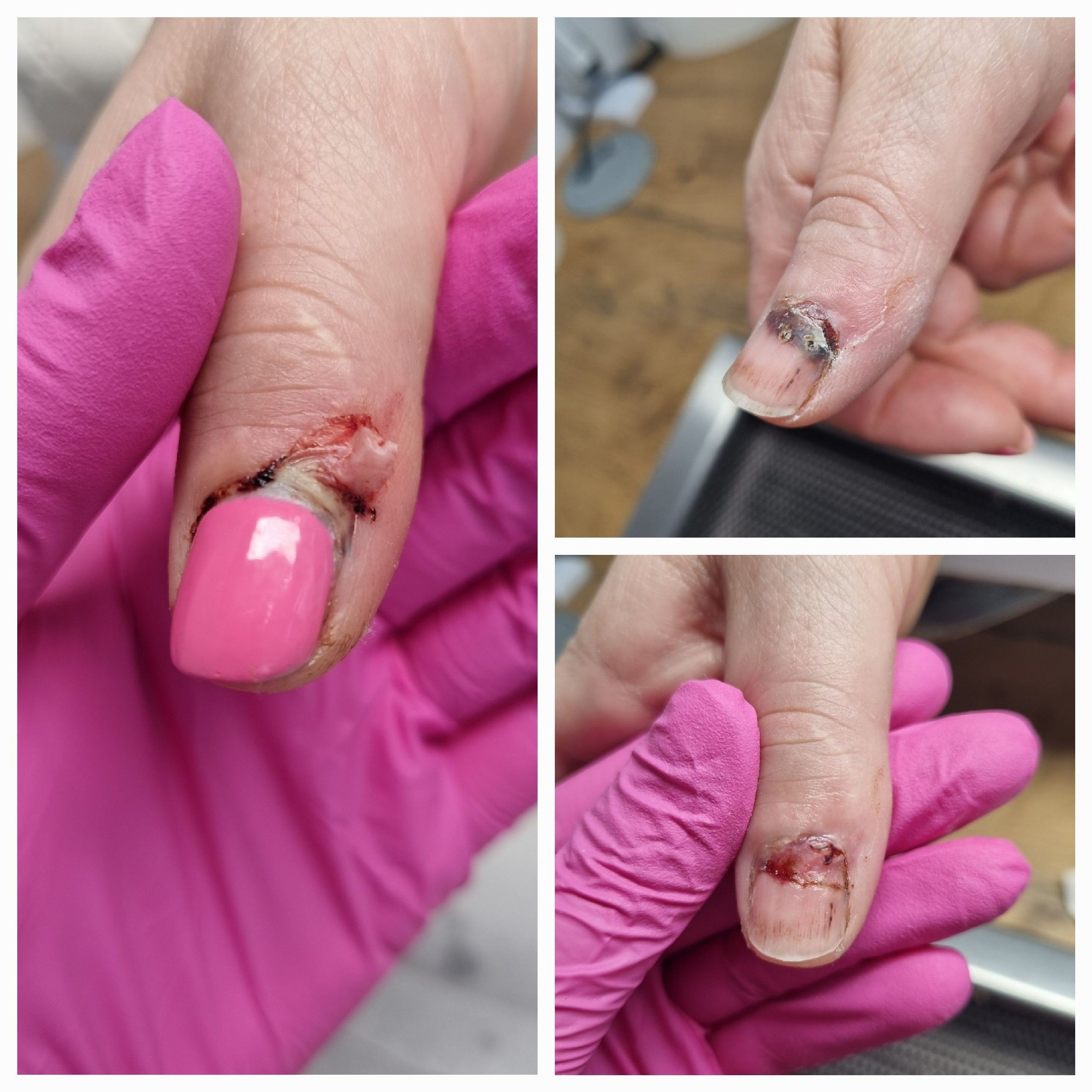 Portfolio usługi Opracowanie paznokci zmienionych chorobowo dłonie