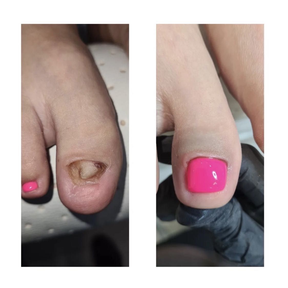 Portfolio usługi Rekonstrukcja paznokcia u stopy