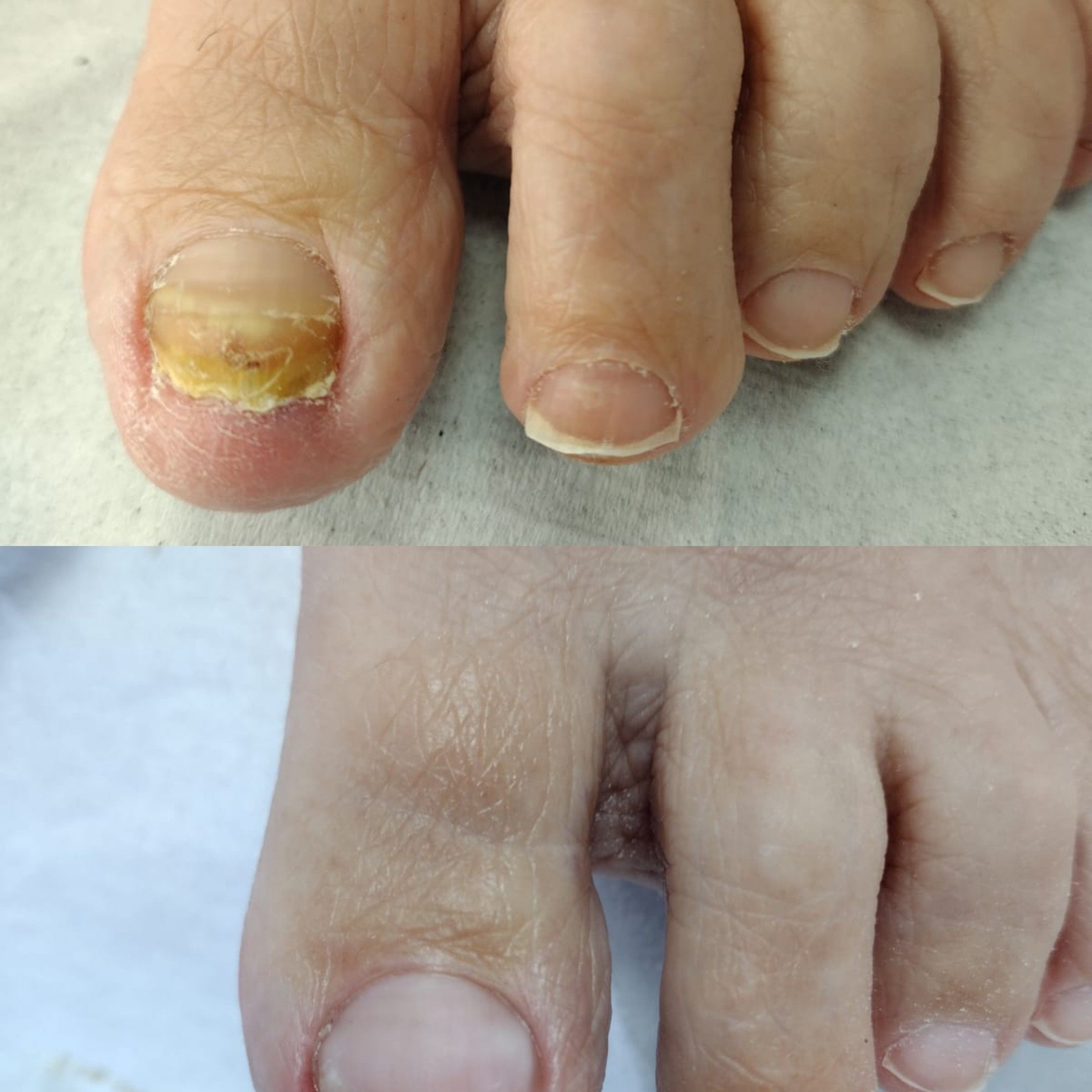 Portfolio usługi Klamra unibrace na wrastające paznokcie