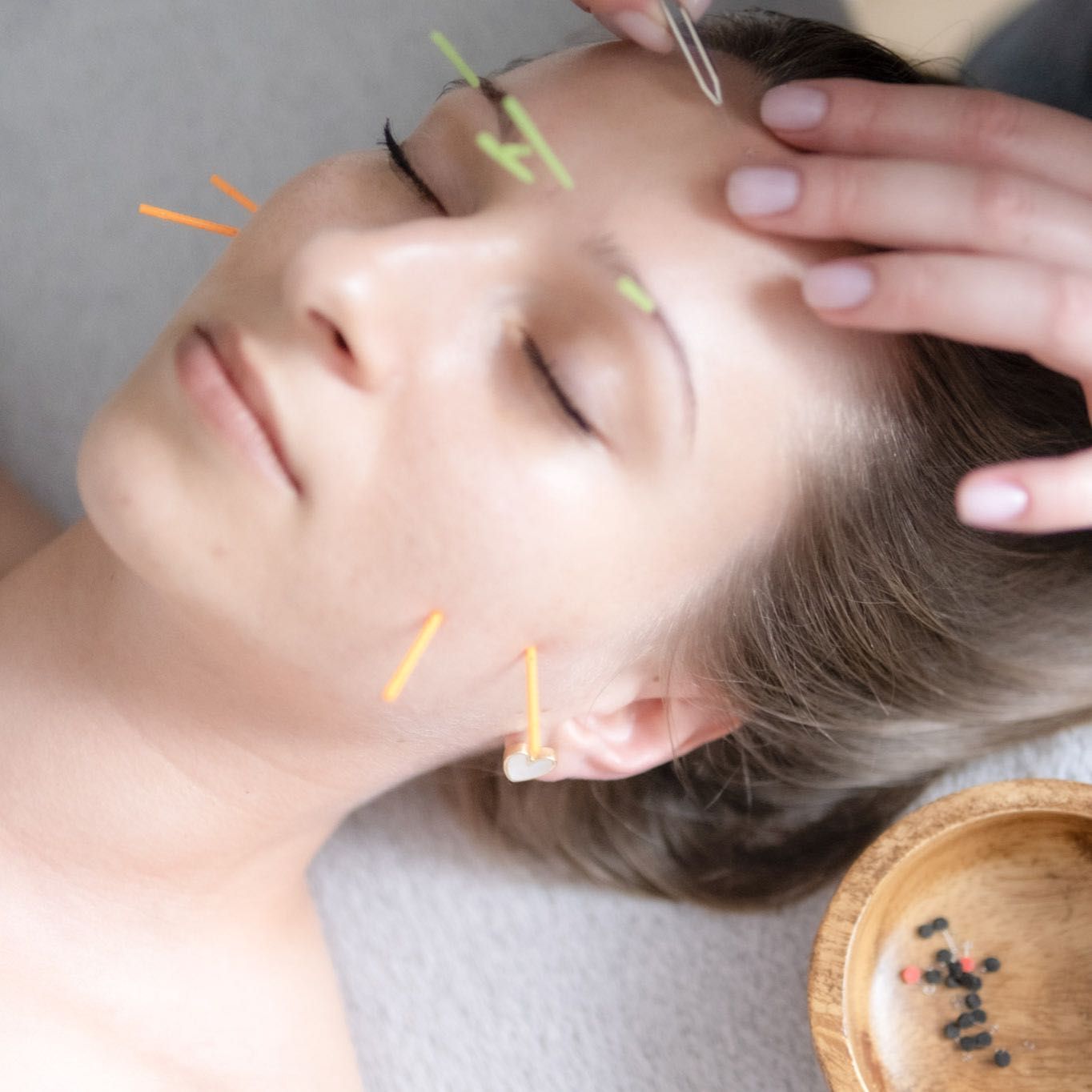 Portfolio usługi Akupunktura kosmetyczna