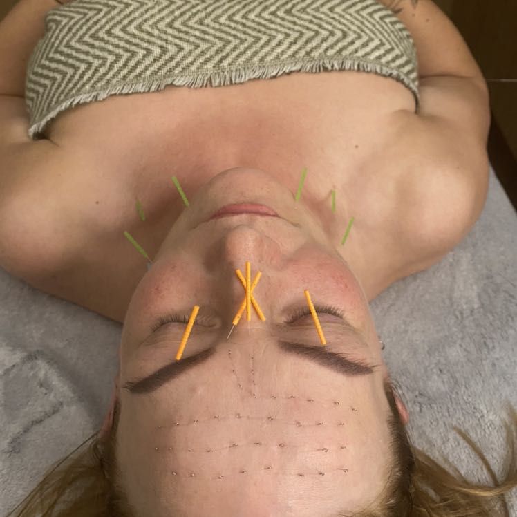 Portfolio usługi Akupunktura kosmetyczna twarzy