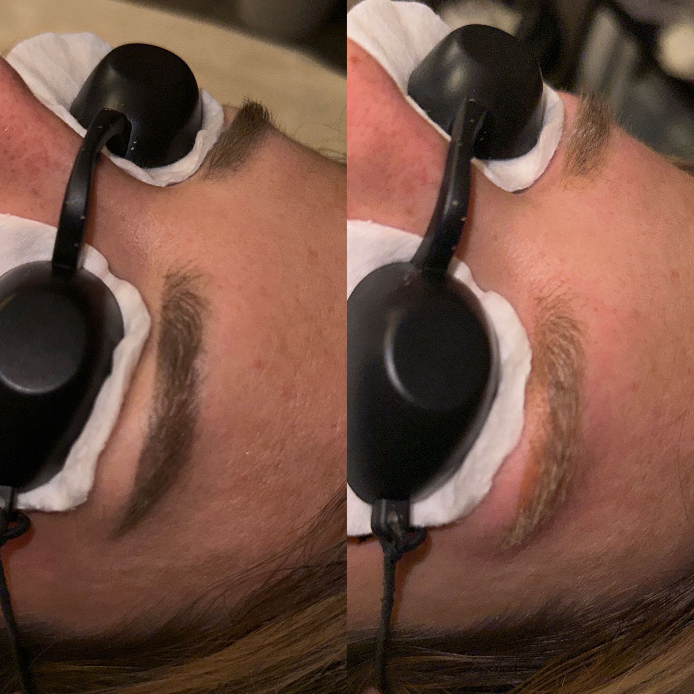 Portfolio usługi Laserowe usuwanie permanentnego makijażu