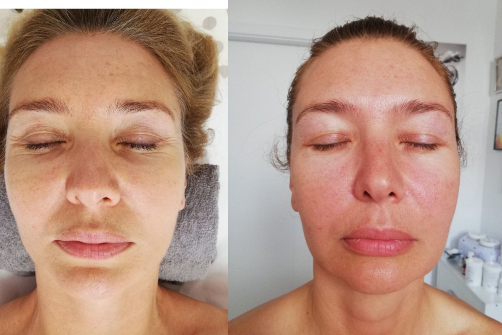 Portfolio usługi Zabieg DERMAPEN + silk collagen twarz+szyja
