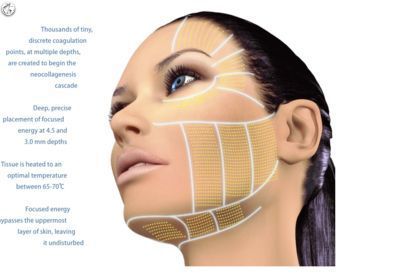 Portfolio usługi HIFU 3D - zabieg na twarz