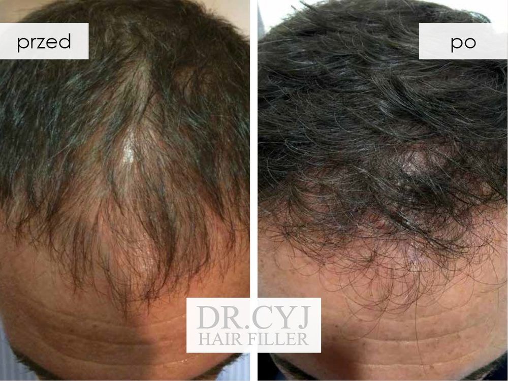 Portfolio usługi Peptydowa terapia Dr Cyj Hair Filler