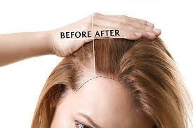 Portfolio usługi Dermapen 4 - leczenie wypadania włosów