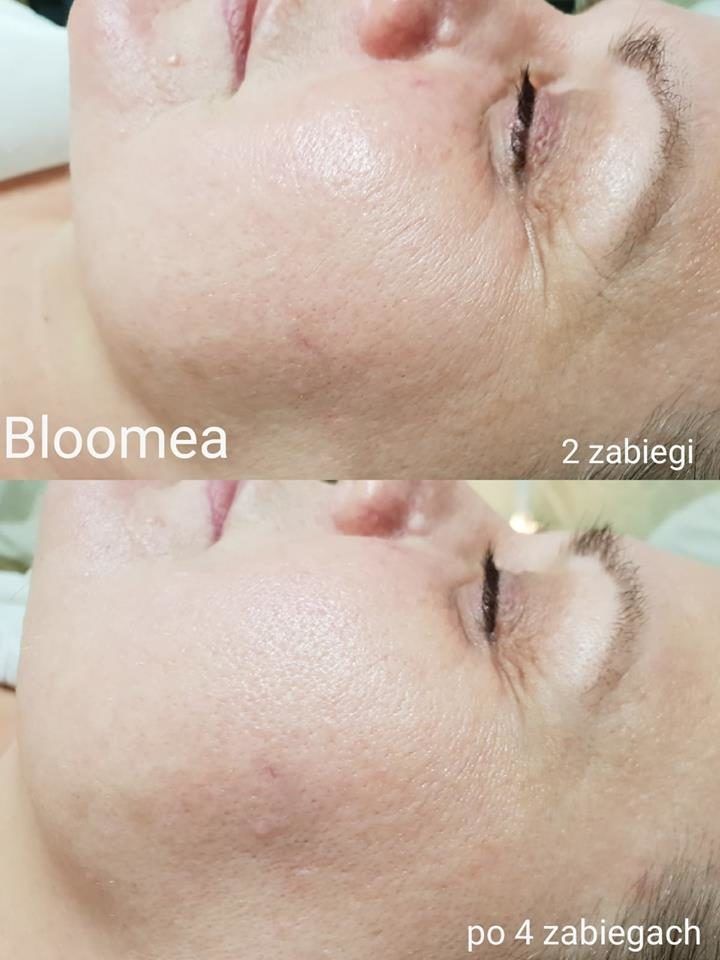 Portfolio usługi Bloomea twarz i szyja