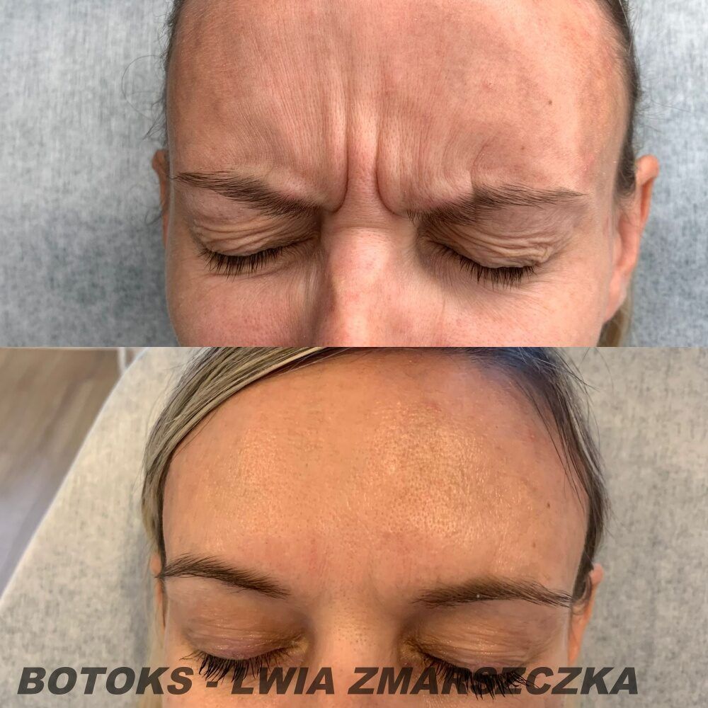 Portfolio usługi Botox. Niwelowanie zmarszczek mimicznych