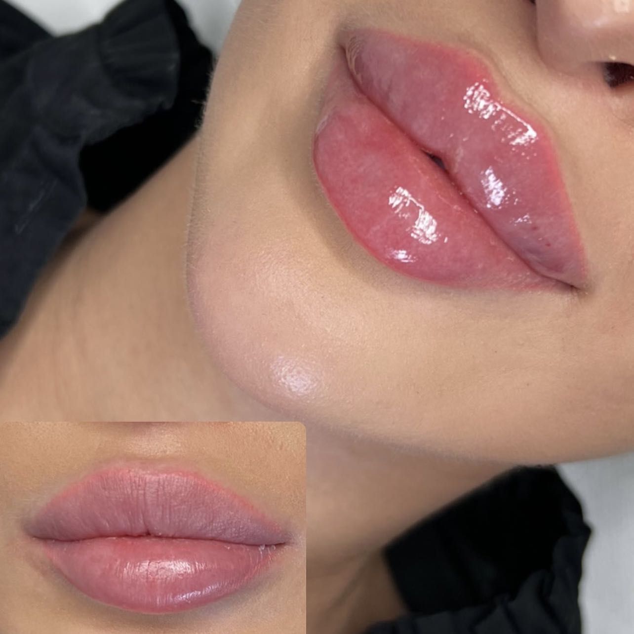 Portfolio usługi Powiększanie ust Perfect Lips Revolax 1.1ml