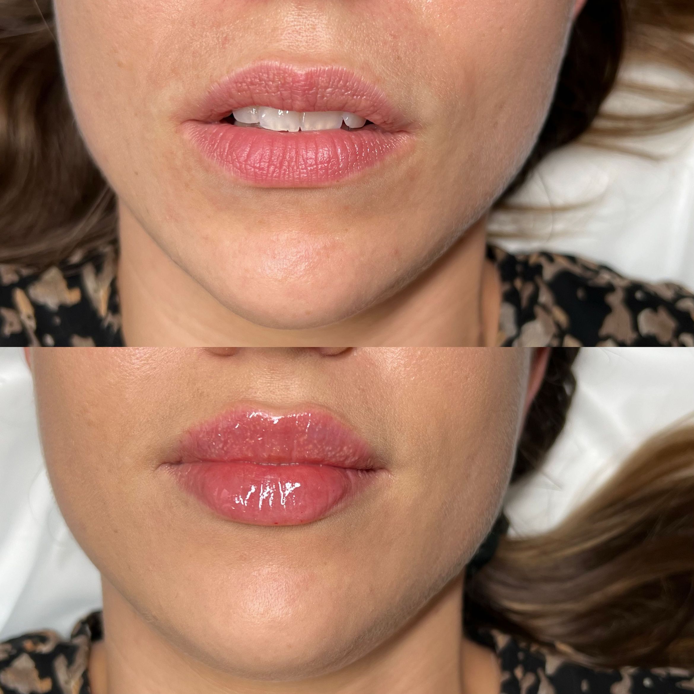 Portfolio usługi Powiększanie ust Perfect Lips Revolax 1.1ml