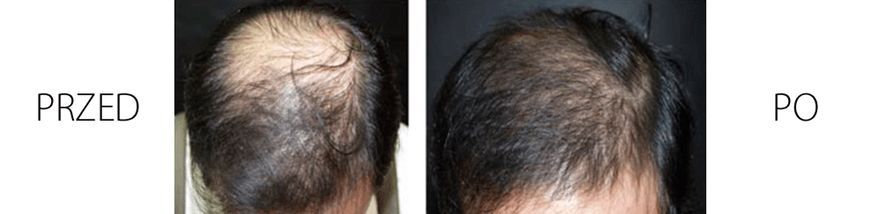 Portfolio usługi Mezoterapia Igłowa Skóry Głowy - DR CYJ