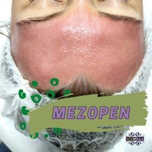 Portfolio usługi MEZOPEN Mezoterapia mikroigłowa z pielęgnacją